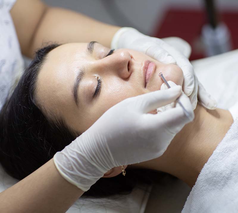 Blackhead cleansing on woman face