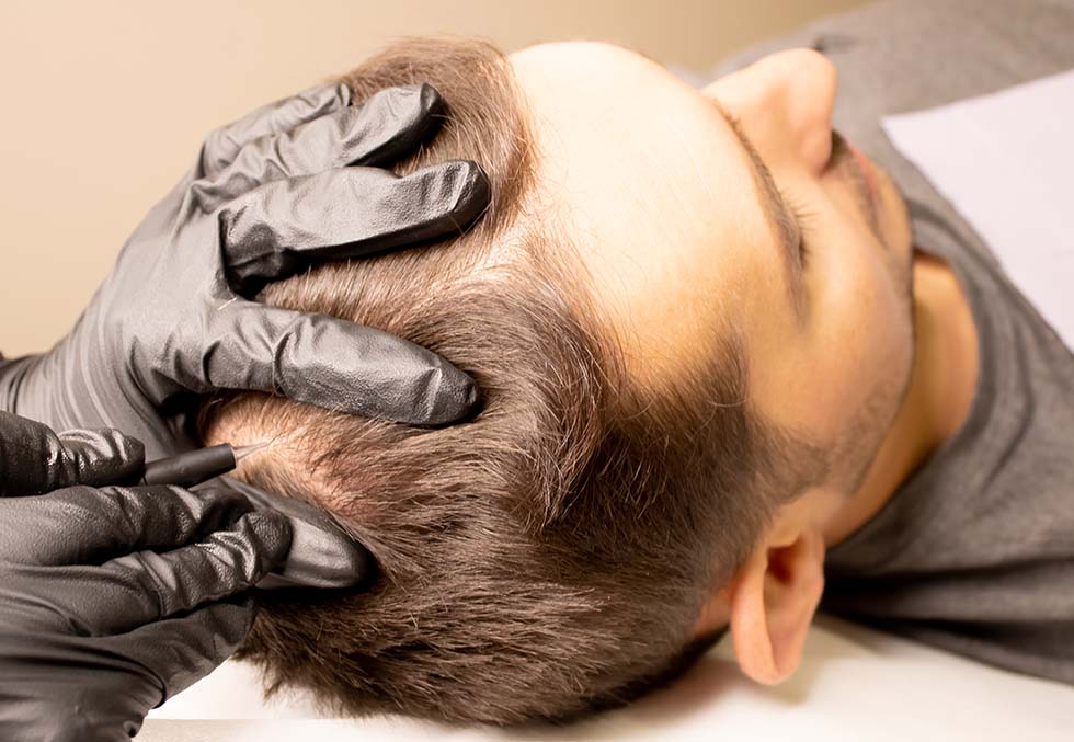 Anti-baldness treatment